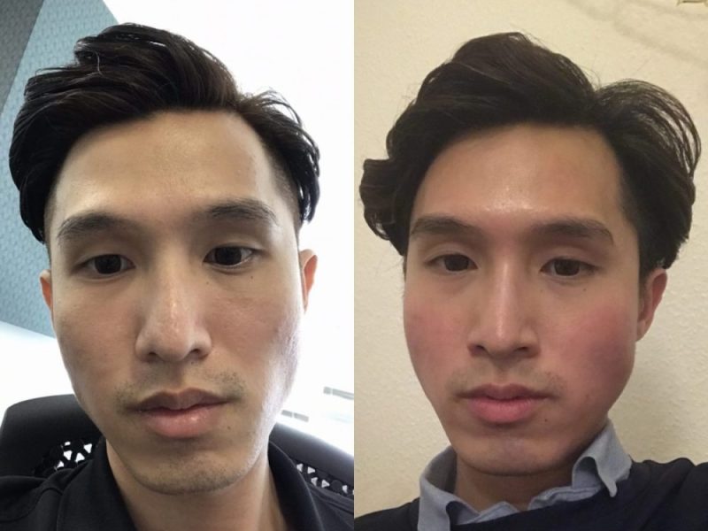 Fillers, Lasers and All That Fun&nbsp;Stuff